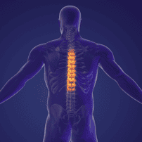 Avoid Long Wait Times for Spinal Fusion Surgery and Discectomy: Choose Mexico